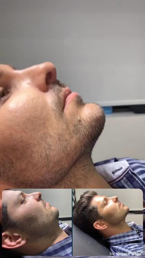 Vídeo antes e depois — contorno facial