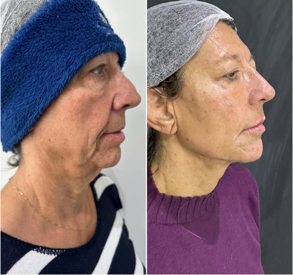Antes e depois — rejuvenescimento full face