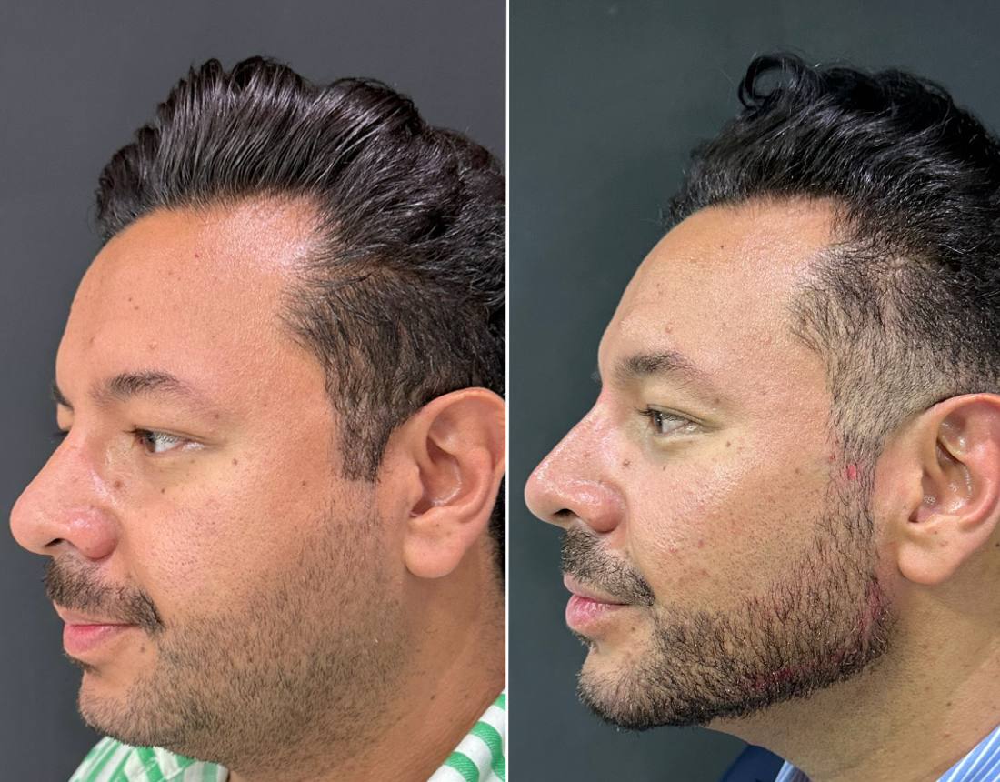 Antes e depois — redefinição mandibular masculina